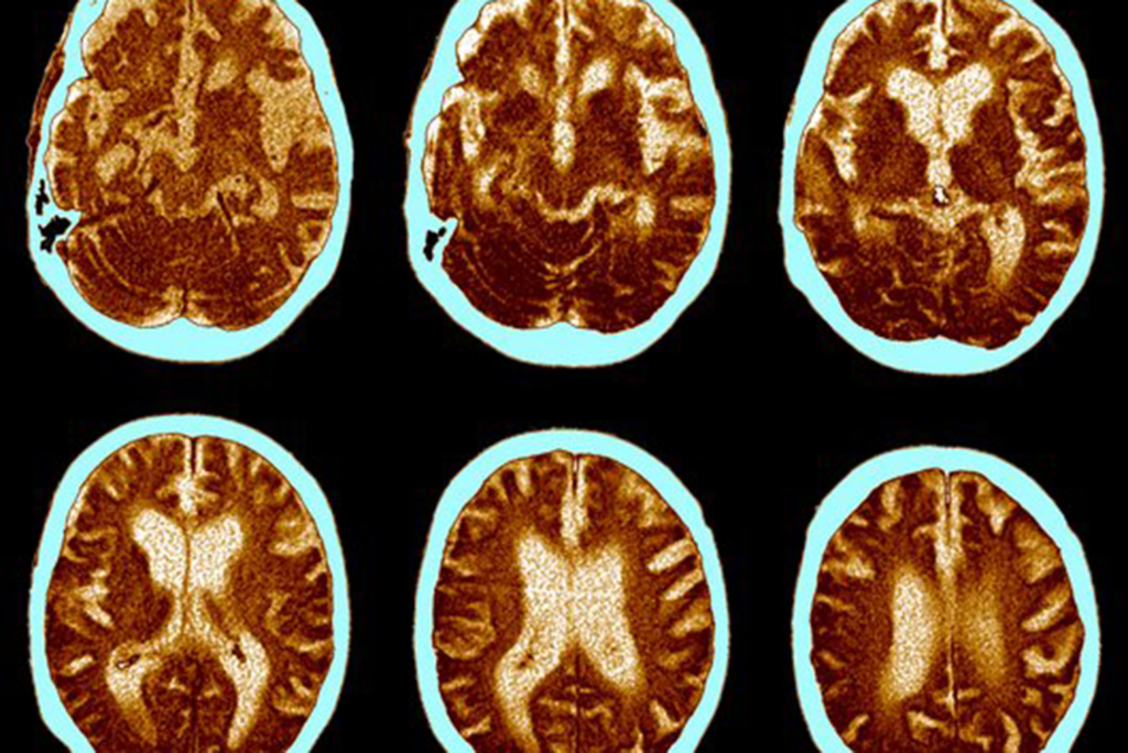 This image shows brain scan images used to examine structural changes associated with Alzheimer's disease. It supports the article by illustrating how AI can analyze medical imaging to assist in the early detection and diagnosis of Alzheimer's.